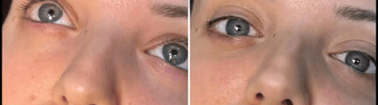 dermalfillers